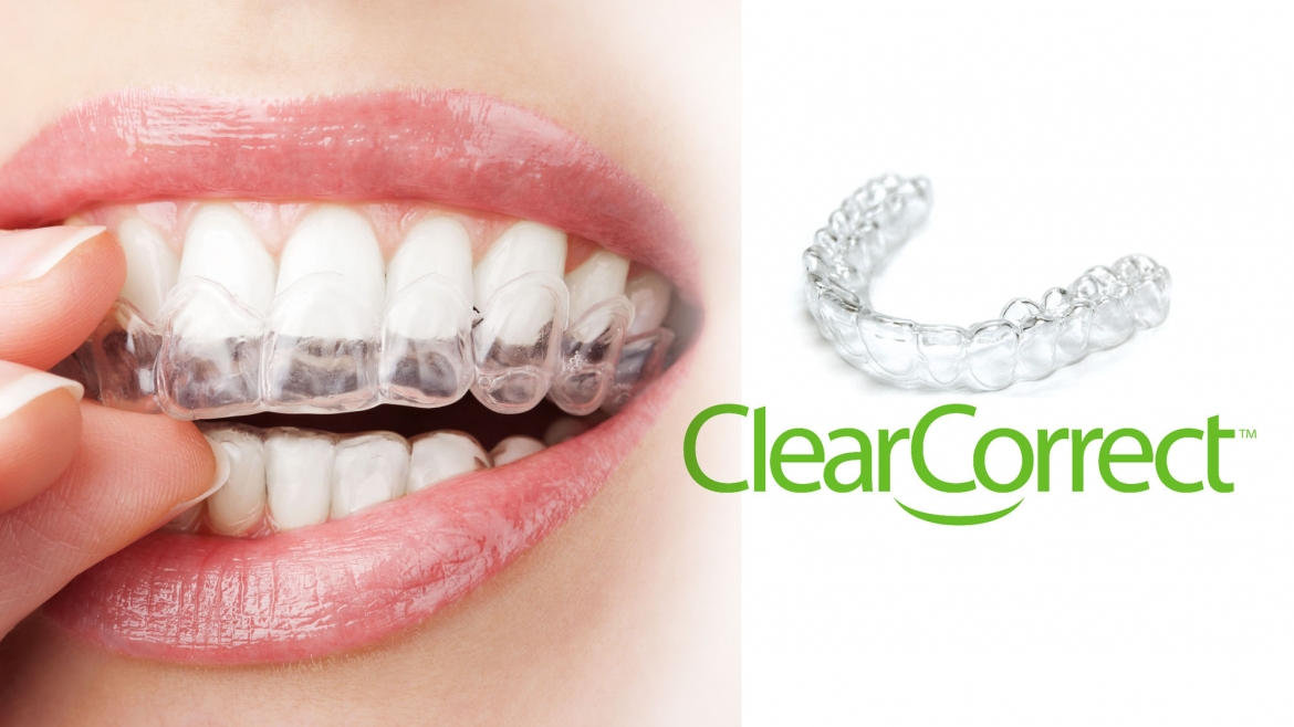 ClearCorrect aligners image