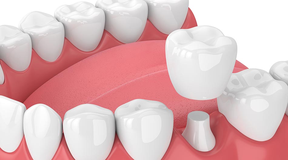 Dental crown image
