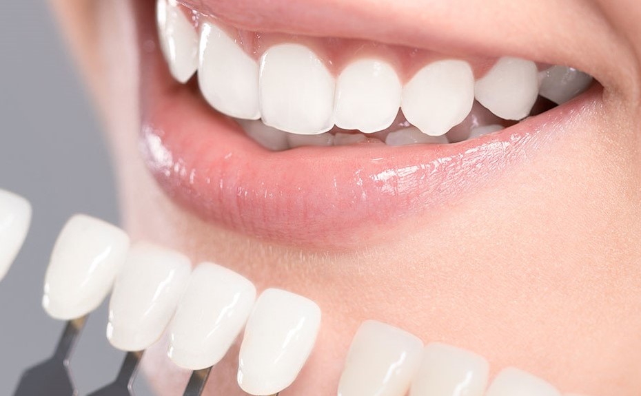 Teeth whitening image