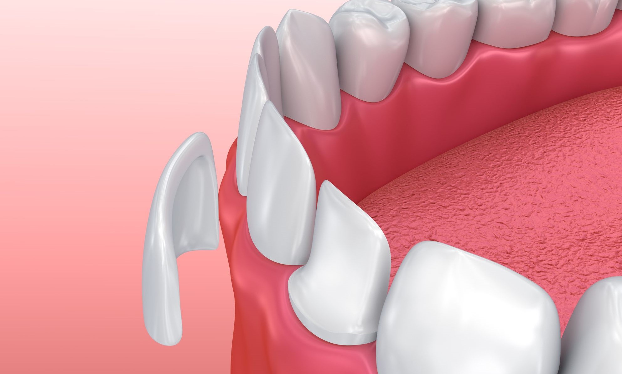 Dental veneer image